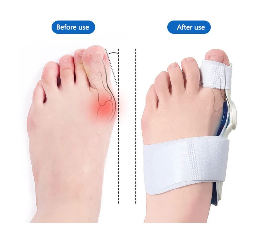 Ip Insoles Αρθρωτός νάρθηκας Βλαισού Μεγάλου Δακτύλου IP 018 αμφιδέξιος